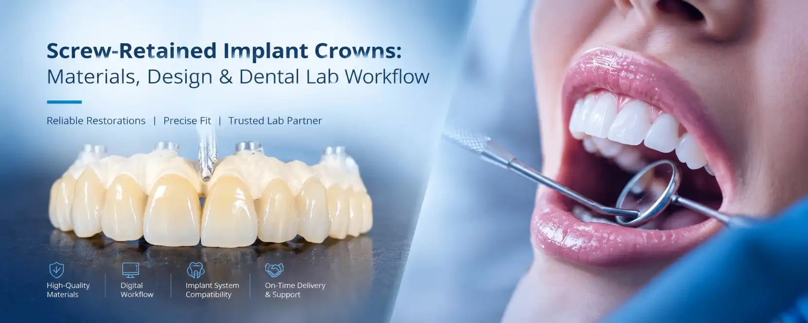 Screw-retained implant crowns Screw-retained implant crowns