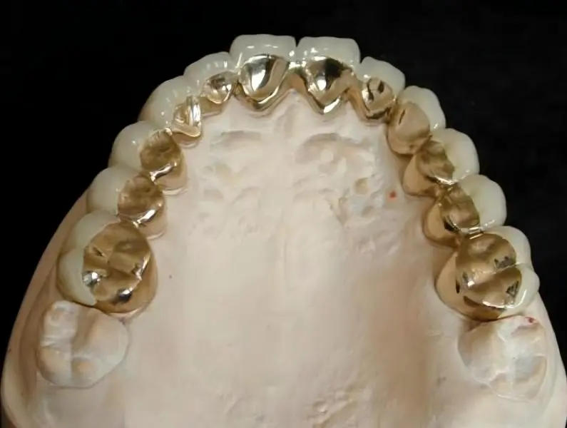High-Noble Full Gold Crowns