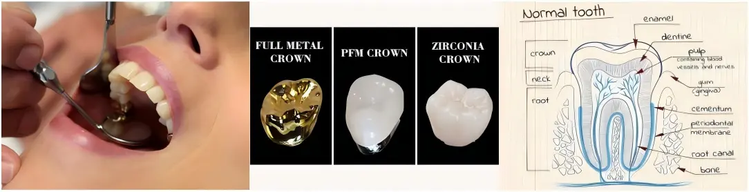 High-Noble Gold (HNG) Crowns High-Noble Gold (HNG) Crowns