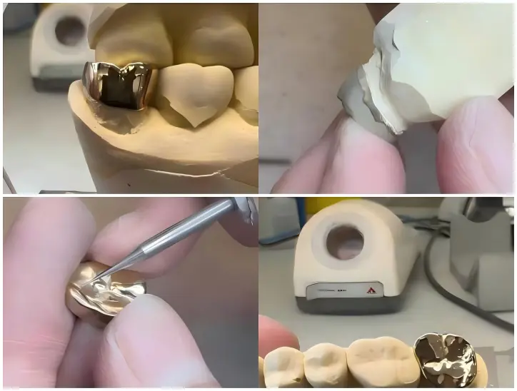 Full Cast Metal Crown