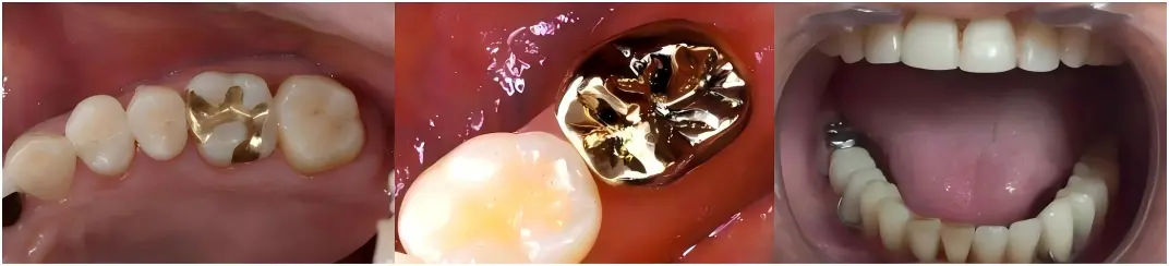 Base Metal Crown