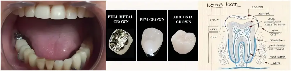 Base Metal (Non-Precious) Full Cast Crowns Base Metal (Non-Precious) Full Cast Crowns