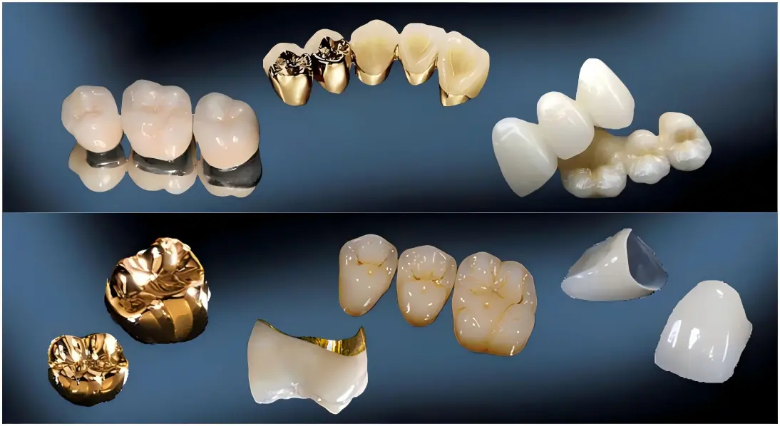 Gold-Ceramic Crown