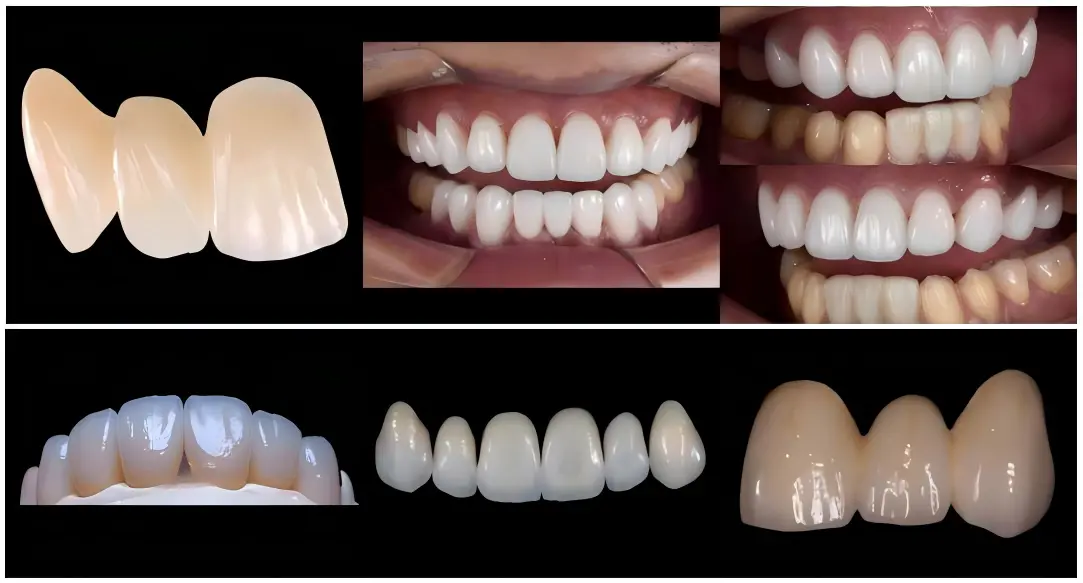 Fully Monolithic Zirconia Fully Monolithic Zirconia