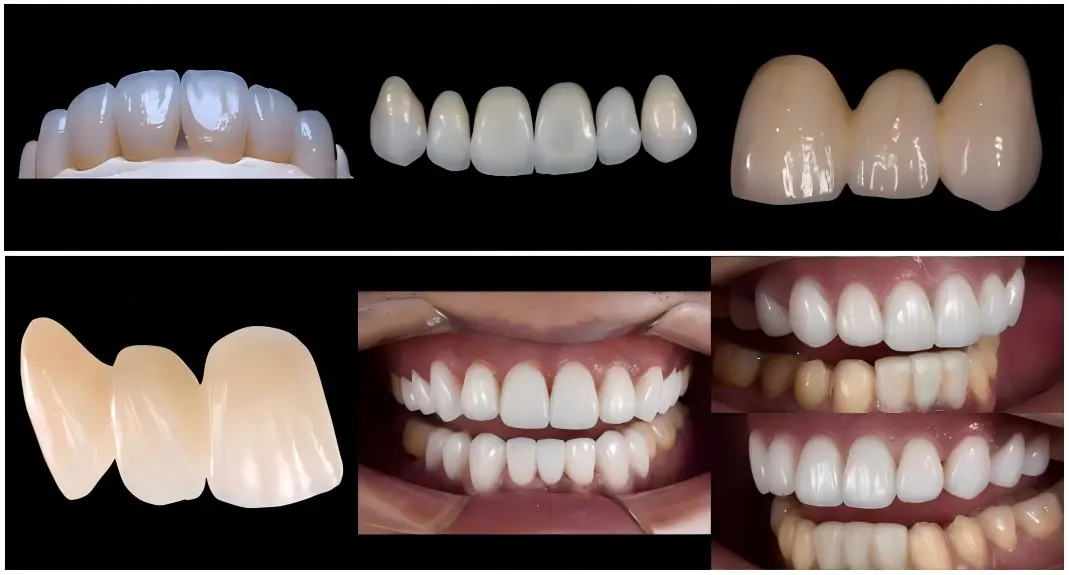 Mono-Block Zirconia