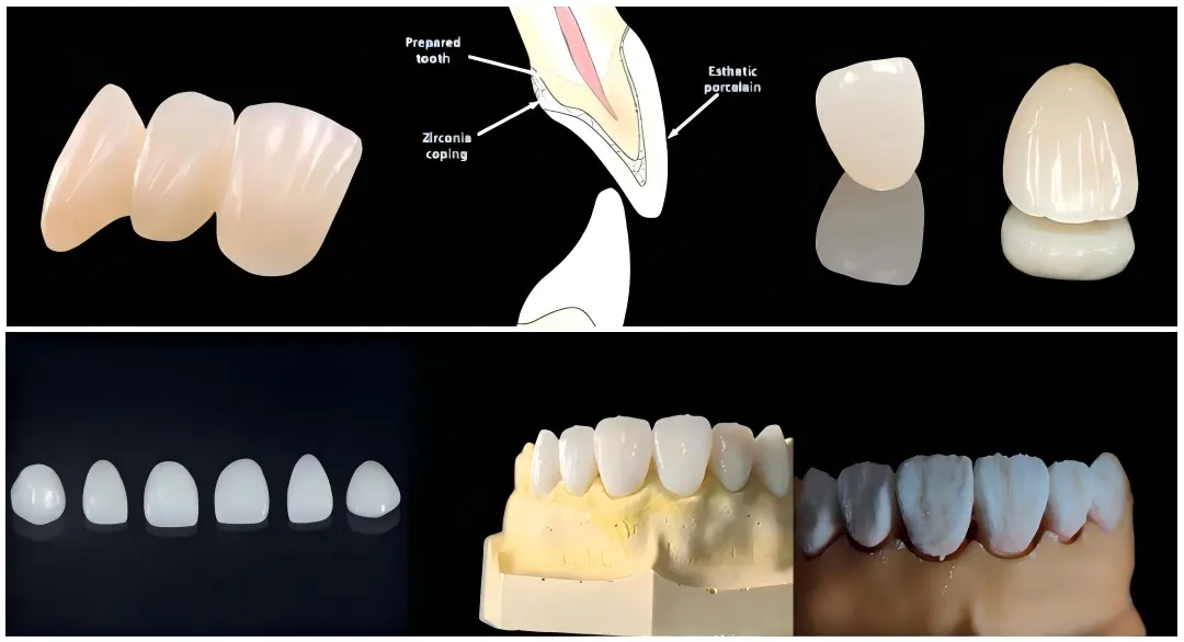 Hybrid Zirconia