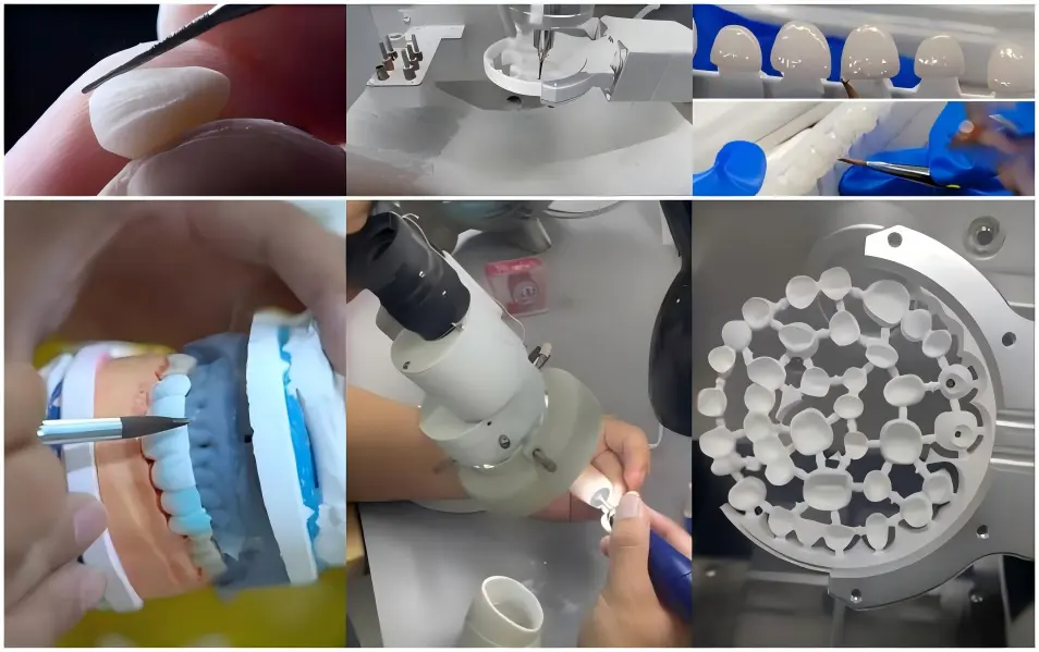 Porcelain-Veneered Zirconia Porcelain-Veneered Zirconia
