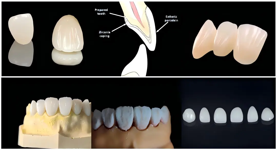 Zirconia-Based Restoration