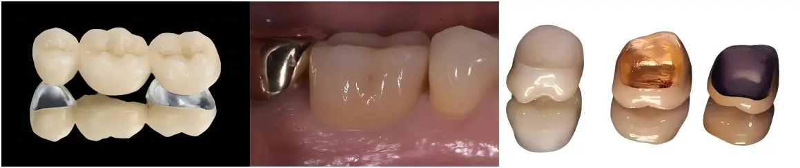 Base Metal PFM