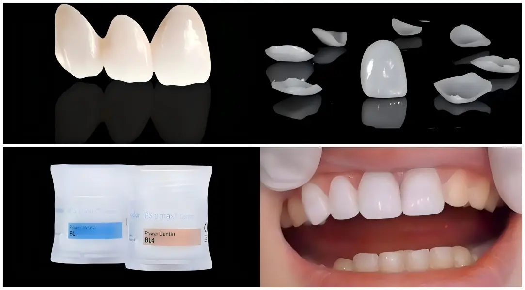 Wafer-Thin Veneers Wafer-Thin Veneers