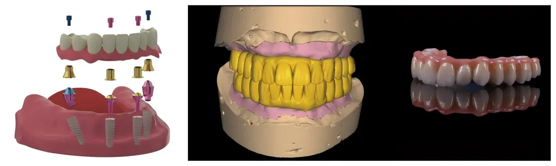 Hybrid Crown-and-Bridge