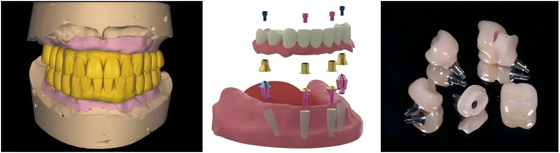 Implant Cemented Crown Implant Cemented Crown