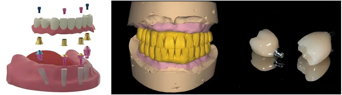 Implant Screw Crown