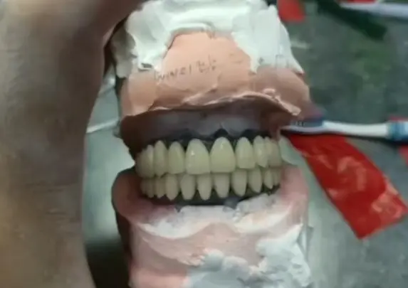 How to Improve PFM Crown Fit and Avoid Marginal Discrepancy & High Occlusion How to Improve PFM Crown Fit and Avoid Marginal Discrepancy & High Occlusion