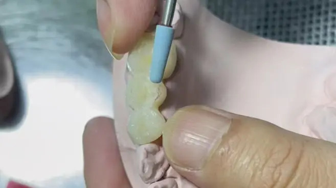 How to Improve PFM Crown Fit and Avoid Marginal Discrepancy & High Occlusion How to Improve PFM Crown Fit and Avoid Marginal Discrepancy & High Occlusion