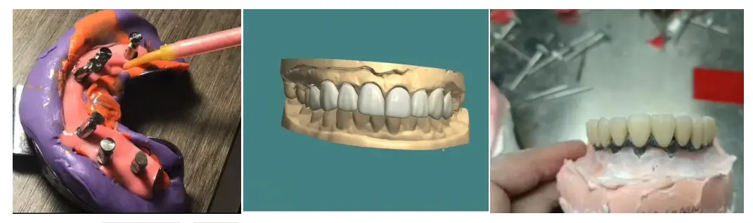 How to Improve PFM Crown Fit and Avoid Marginal Discrepancy & High Occlusion
