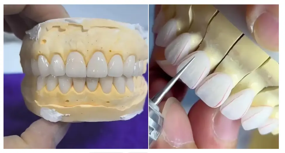 How to Improve PFM Crown Fit and Avoid Marginal Discrepancy & High Occlusion