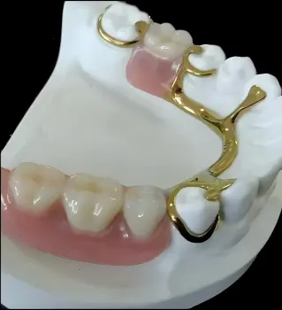 Titanium Partials