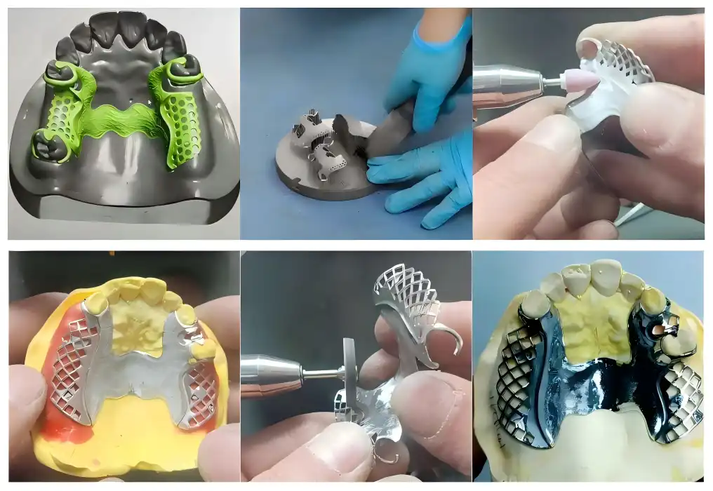 Titanium Partials