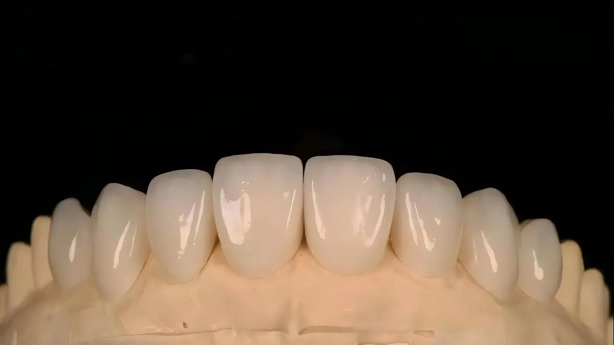 FCZ (Full Contour Zirconia)