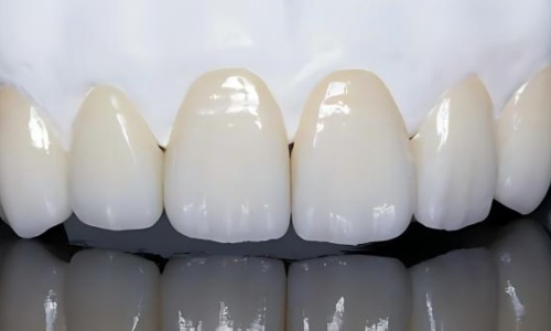 Importance of Layered Zirconia in High-End Crown and Bridge Restorations