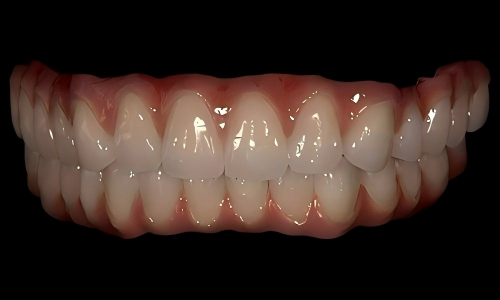 All-on-X vs Traditional Implants: Which Is Better for Full Mouth Tooth Loss?
