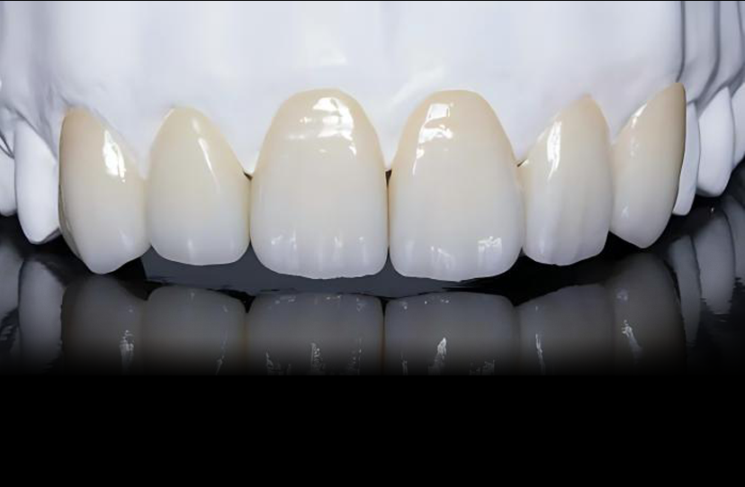 Ceramic-Fused-to-Zirconia